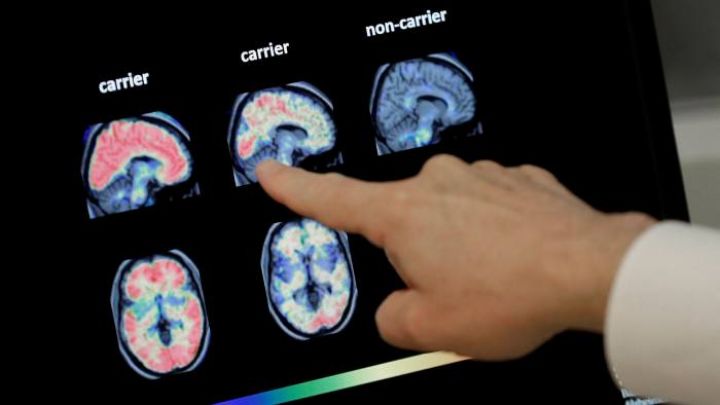 İnqilabi yenilik ola biləcək dərman - Alzheimer üçün çarə gəlir!